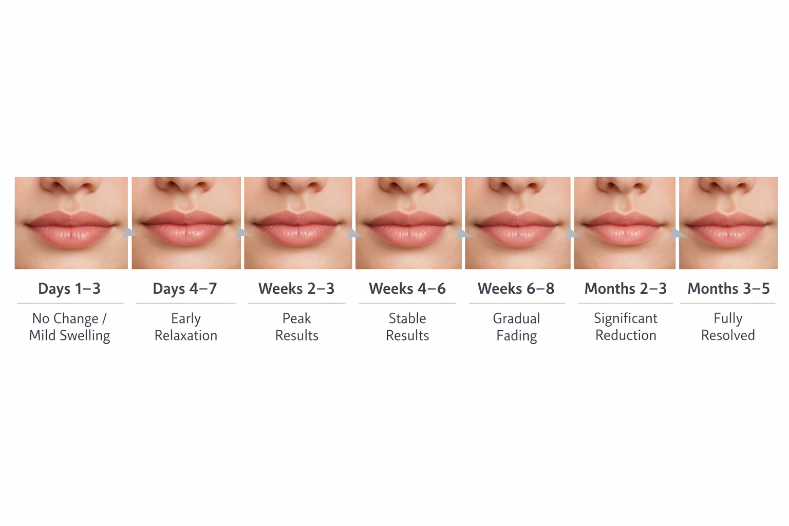 Week-by-week lip flip results timeline from injection day to full resolution at 3 to 5 months