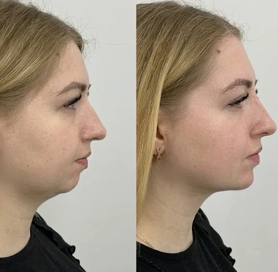 After jawline filler treatment.