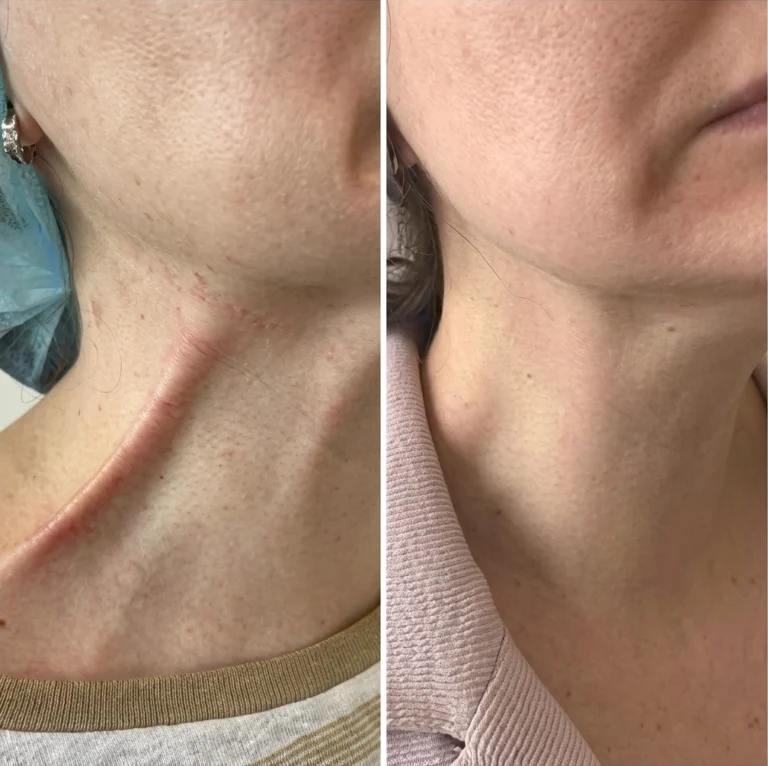 nefertiti-filler-treatment