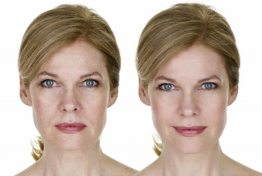 Before and after Restylane Dermal Filler Treatment rejuvenating the face with smoother skin and reduced wrinkles.