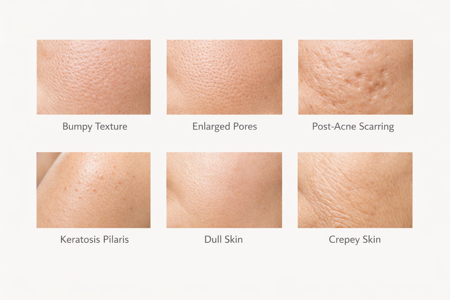 Infographic showing six types of textured skin including enlarged pores and keratosis pilaris
