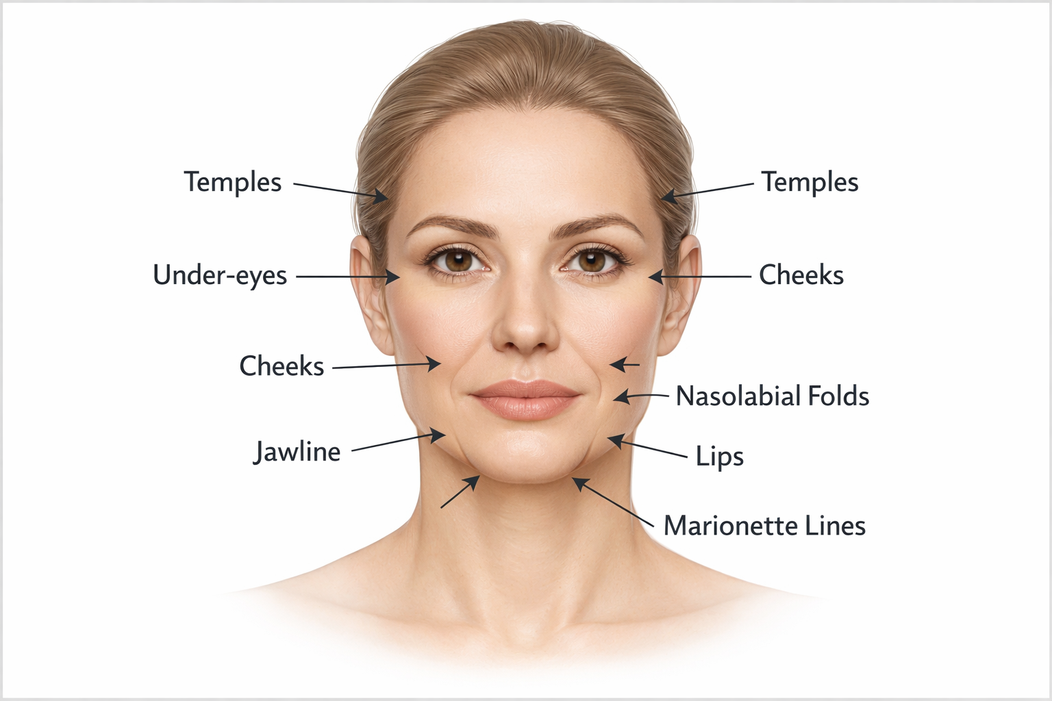 Medical illustration of face showing areas most affected by facial volume loss