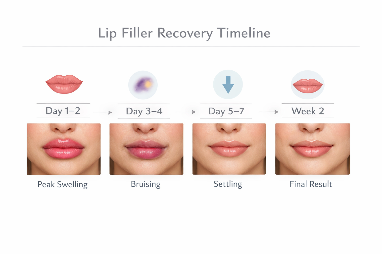 Lip filler recovery timeline showing swelling and bruising stages from day one to week two