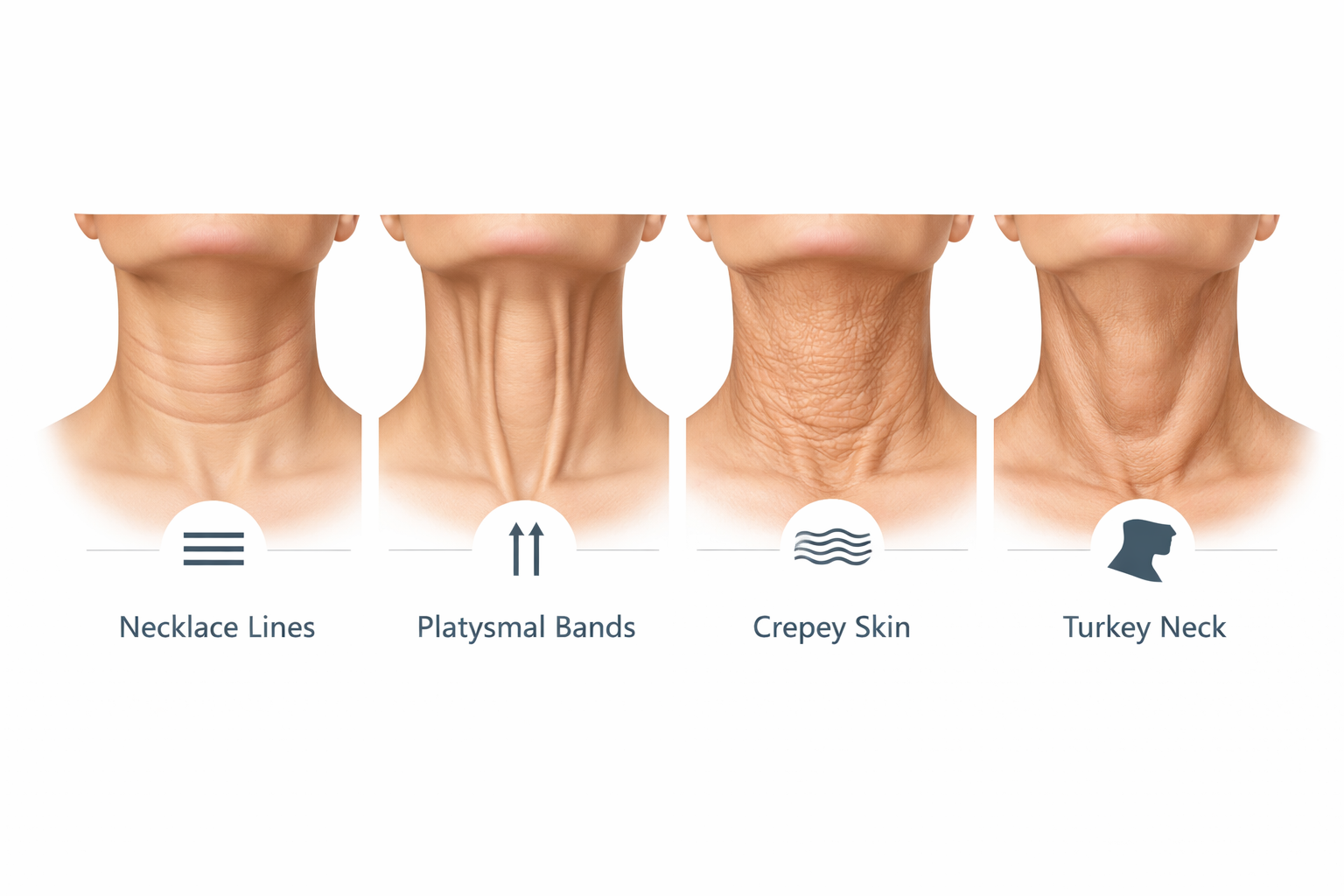 Infographic comparing four types of neck wrinkles: necklace lines, platysmal bands, crepey skin